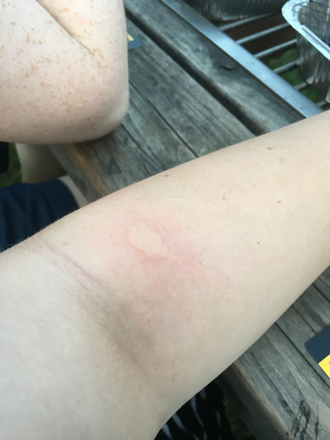 Mosquito bite on my arm allergic reaction 2021